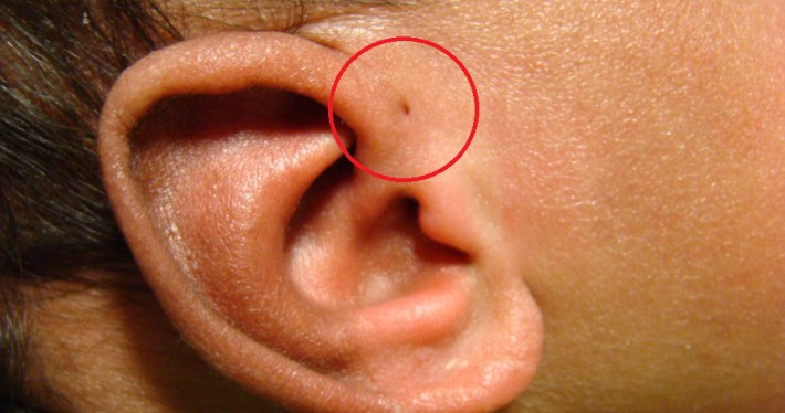 Προωτικός κολπίσκος: Τι είναι η μικροσκοπική τρύπα που έχουν κάποιοι πάνω από το αυτί;