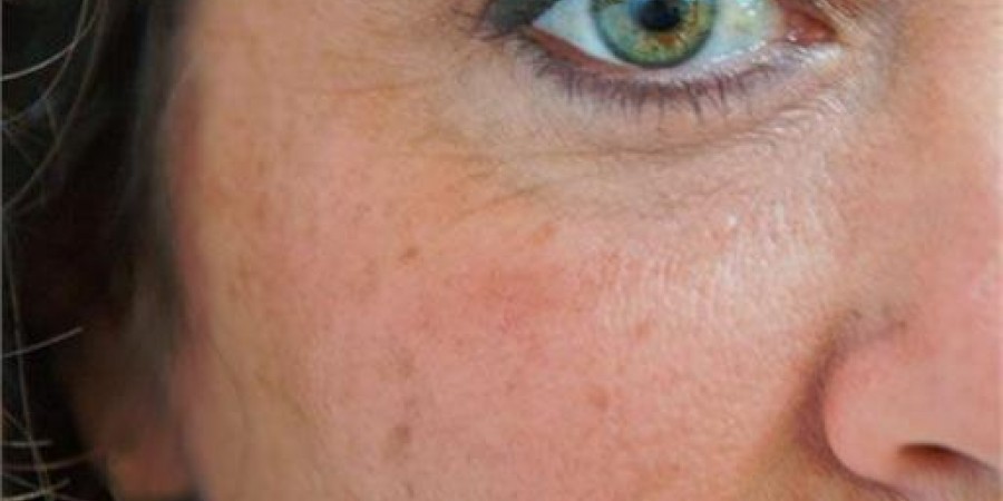 Καφέ κηλίδες στο δέρμα: Πως δημιουργούνται και τι να κάνετε για να τις προλάβετε πριν εμφανιστούν