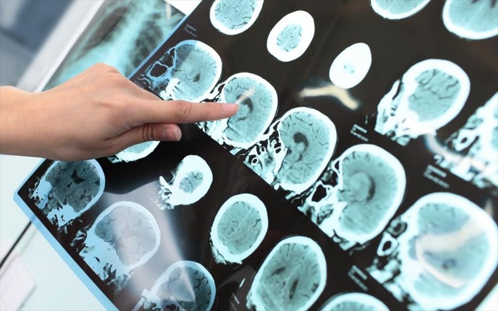 Νέες επικρίσεις κατά του FDA για την ταχεία έγκριση του φαρμάκου κατά του Αλτσχάιμερ