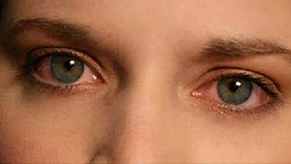Αλλεργία στα μάτια: Τι πρέπει να κάνετε για τη φαγούρα, το κοκκίνισμα και τα δάκρυα