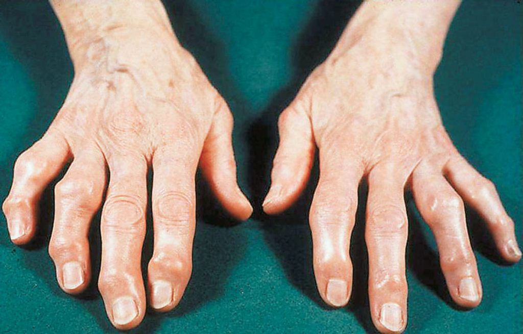 Οστεοαρθρίτιδα: Μπορεί να ξεκινήσει και λόγω διατροφής – Τι πρέπει να αποφεύγετε