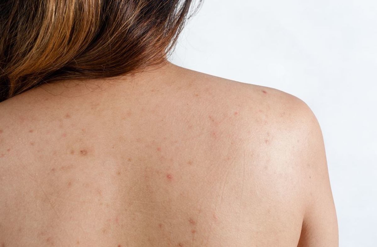 Να τι μπορείτε να κάνετε για τα σπυράκια στην πλάτη λόγω ζέστης και ιδρώτα το καλοκαίρι