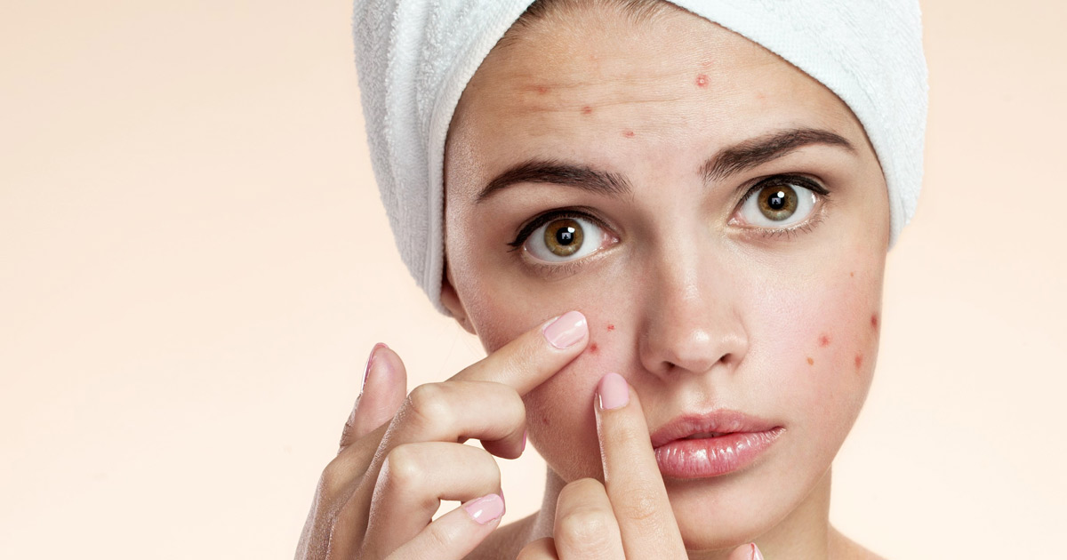 Ακμή: Αυτές είναι οι επτά τροφές που την προκαλούν