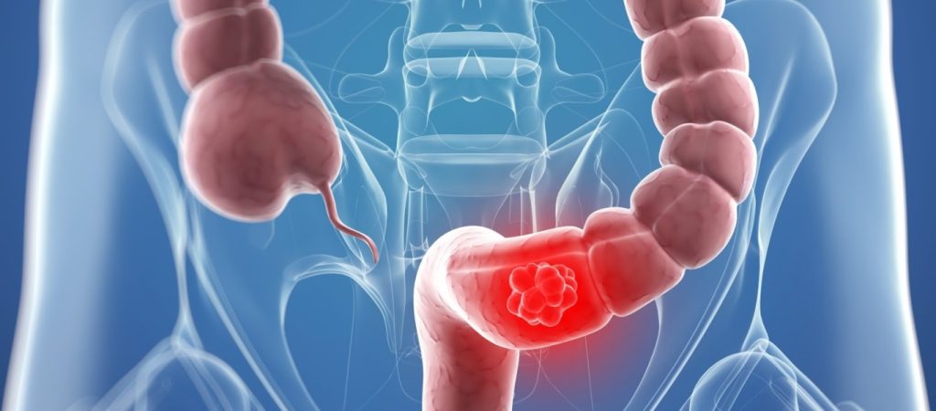 O ήλιος μπορεί να συμβάλλει στην πρόληψη καρκίνου σε μέρος του εντέρου