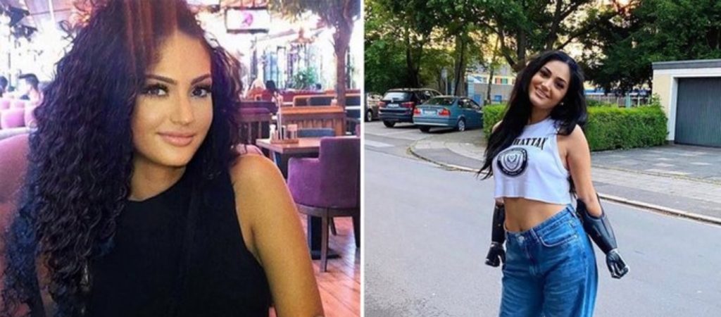 Τουρκία: 24χρονη έχασε τα άκρα της λόγω μίας σπάνιας ασθένειας (φώτο)