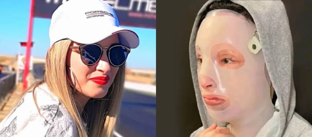 Στην Γαλλία η Ιωάννα Παλιοσπύρου για ειδική φροντίδα των εγκαυμάτων της