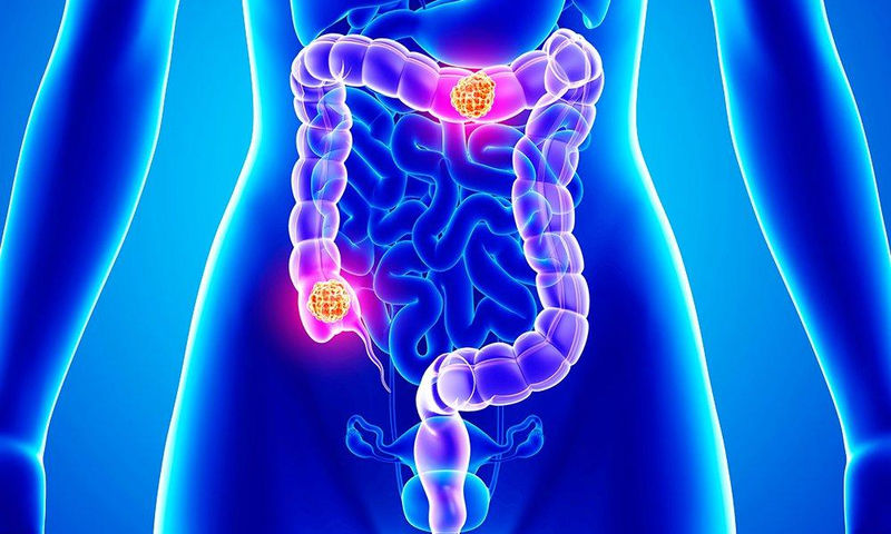 Καρκίνος του παχέος εντέρου: Πρόληψη μέσω της διατροφής – Oι τέσσερις «θαυματουργές» τροφές