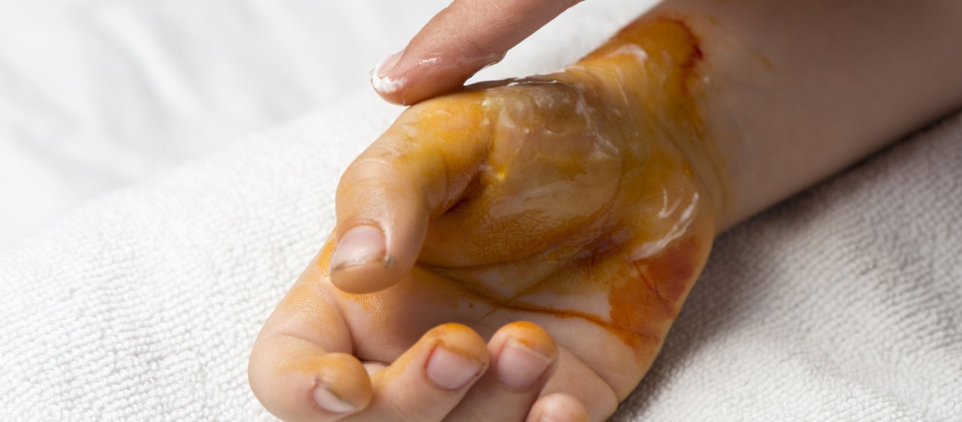 Θερμικό, χημικό, ή έγκαυμα στην κουζίνα; – Τι να κάνετε στην κάθε περίπτωση (βίντεο)