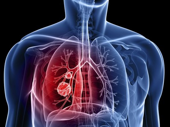 Καρκίνος του πνεύμονα: Αν δείτε αυτό το σημάδι στο φλέγμα σας πρέπει να πάτε αμέσως στο γιατρό
