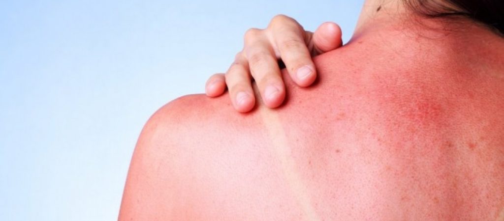 Δείτε πώς να περιορίσετε την φαγούρα από το ηλιακό έγκαυμα