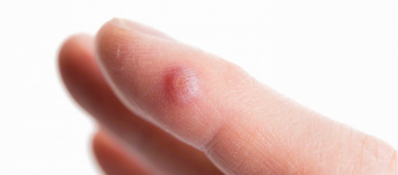 Κονδυλώματα: Τελικά μπορεί να μεταδοθεί ο ιός HPV με τα χέρια;