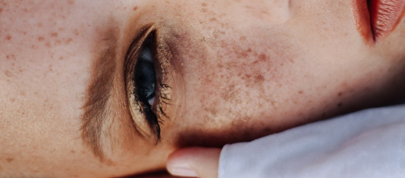 Δείτε τι πρέπει να κάνετε για να να αποφύγετε τις φακίδες το καλοκαίρι