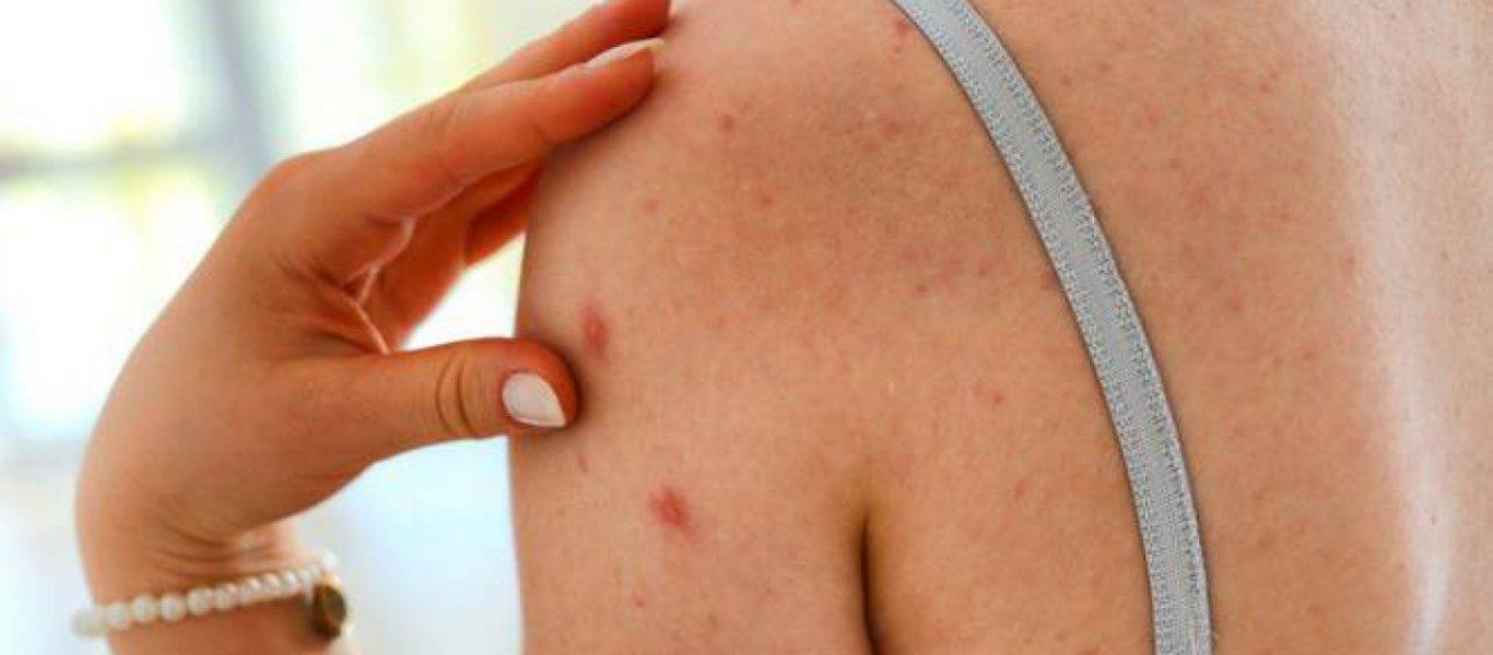 Πώς θα προστατευτείτε από τον καρκίνο του δέρματος