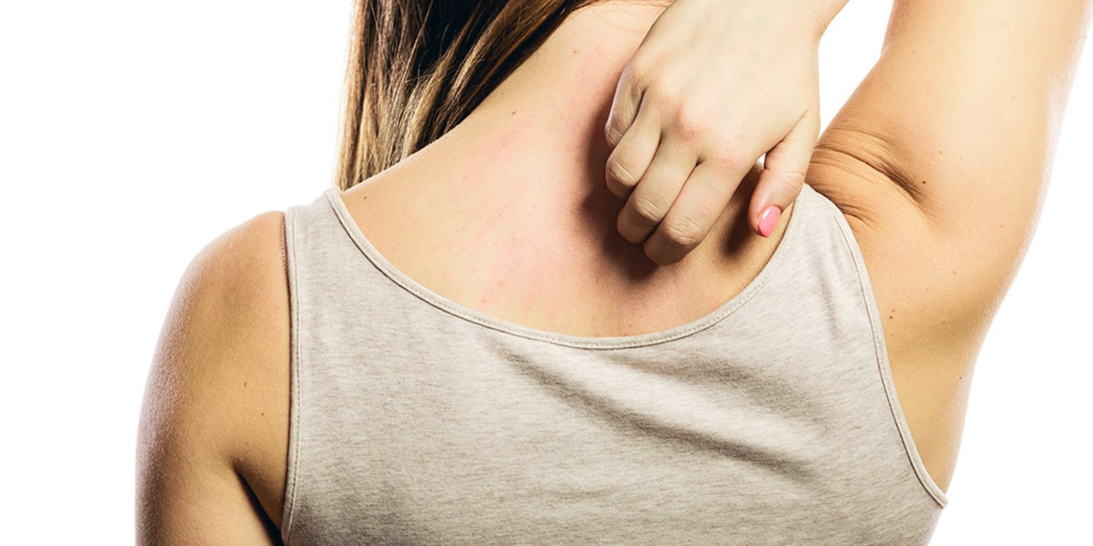 Τσίμπημα από κουνούπι: Δείτε τι πρέπει να βάλετε για να σταματήσει η φαγούρα