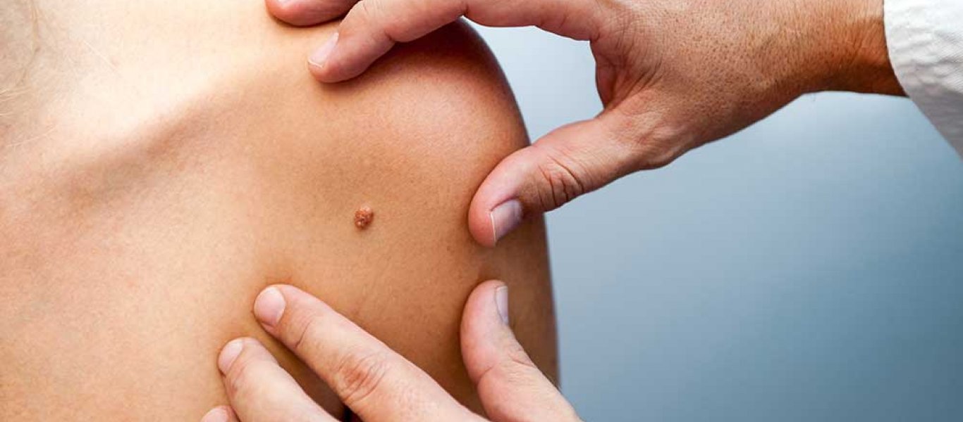 Καρκίνος του δέρματος: Τα συμπτώματά του και η διαφορά με το μελάνωμα – Όσα πρέπει να ξέρετε