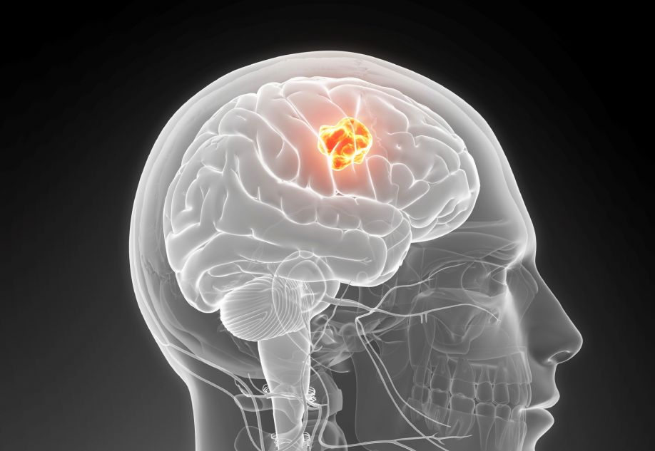 Ψευδοόγκος εγκεφάλου: Τι ακριβώς είναι – Αίτια, συμπτώματα και θεραπεία