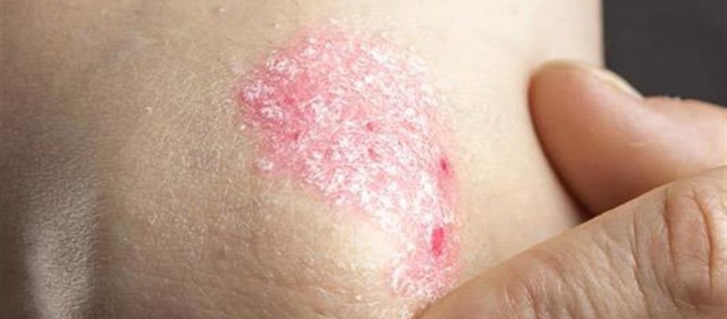 Η λίστα των τροφών που επιδεινώνουν την ψωρίαση – Τι θα πρέπει να αποφύγετε