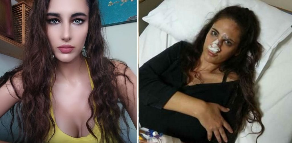 Τρίτο χειρουργείο για το «κορίτσι του Θέμου» που έπεσε θύμα ξυλοδαρμού από τον πρώην σύντροφό της (φωτό)