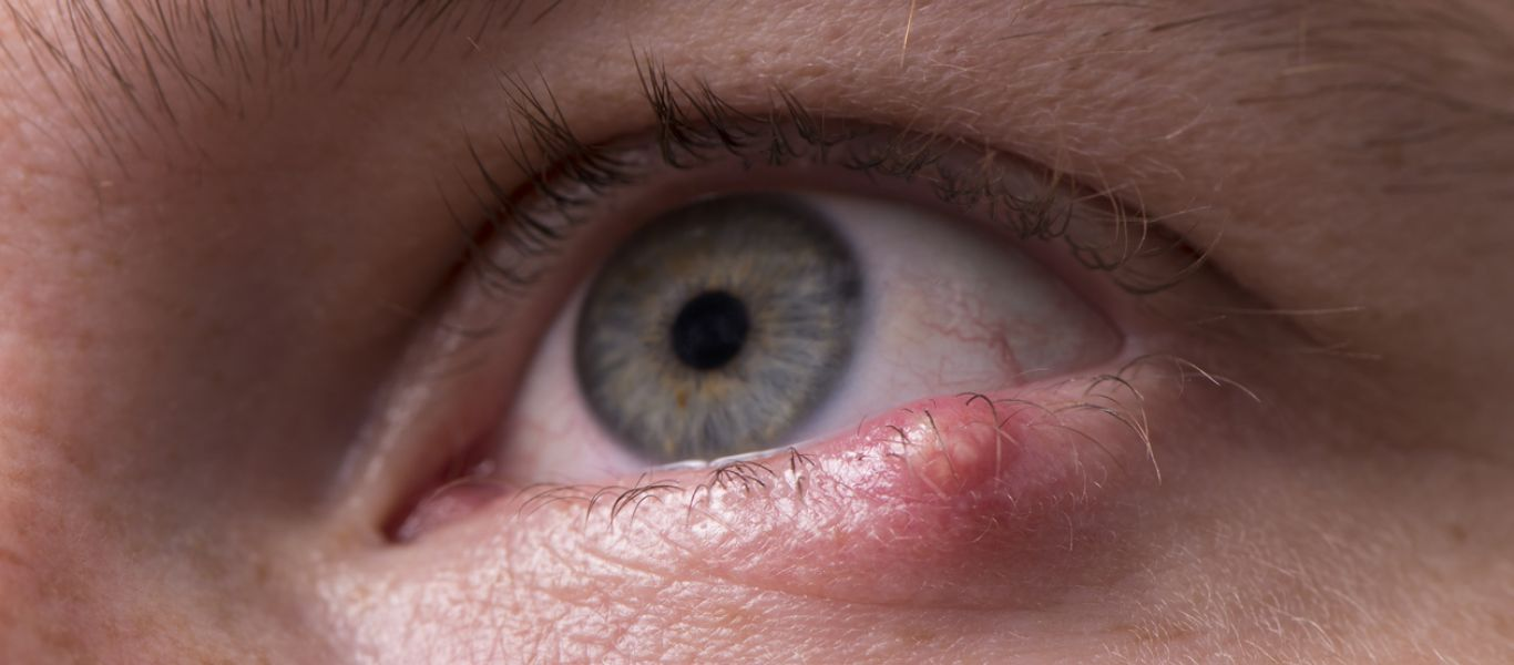Κριθαράκι στο μάτι: Οι 9 τρόποι για να απαλλαγείτε άμεσα