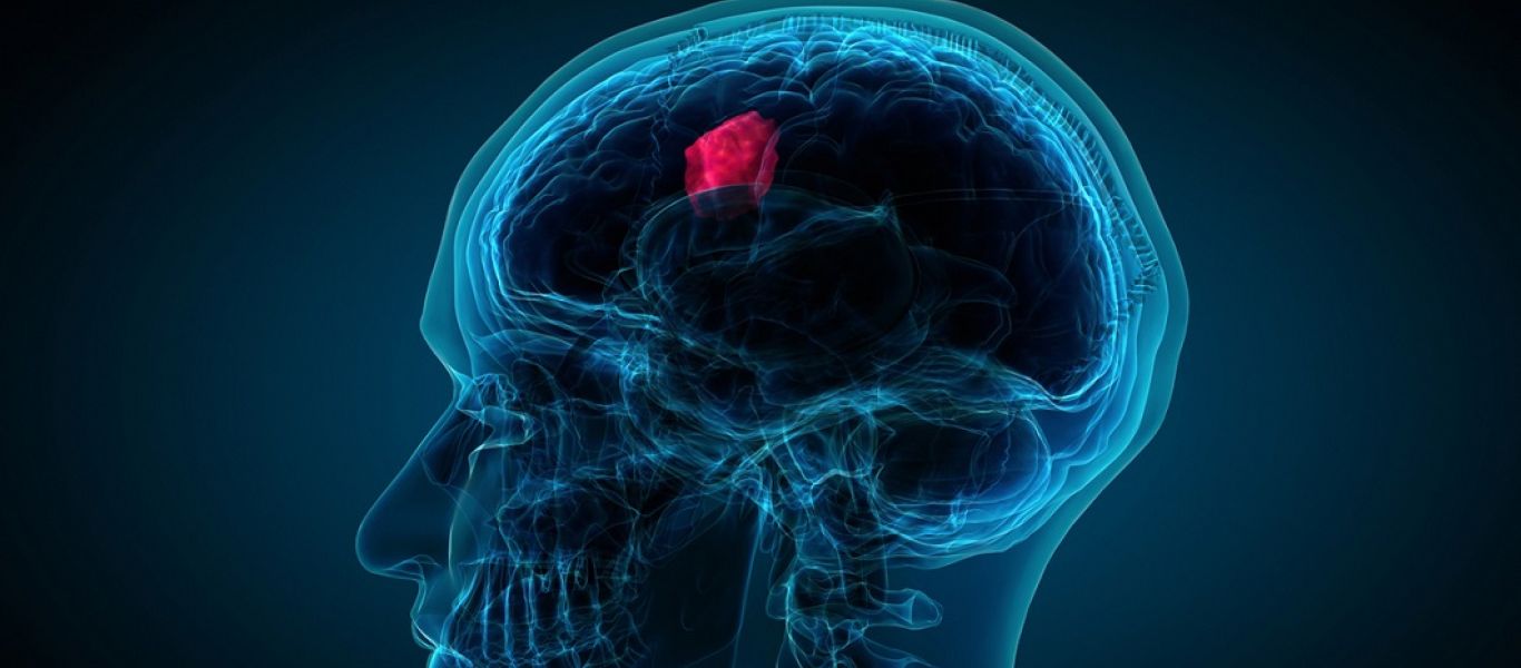 «Έρχεται» το τέλος του καρκίνου του εγκεφάλου; – Ανακαλύφθηκε νέα «υπερηχητική» μέθοδος θεραπείας