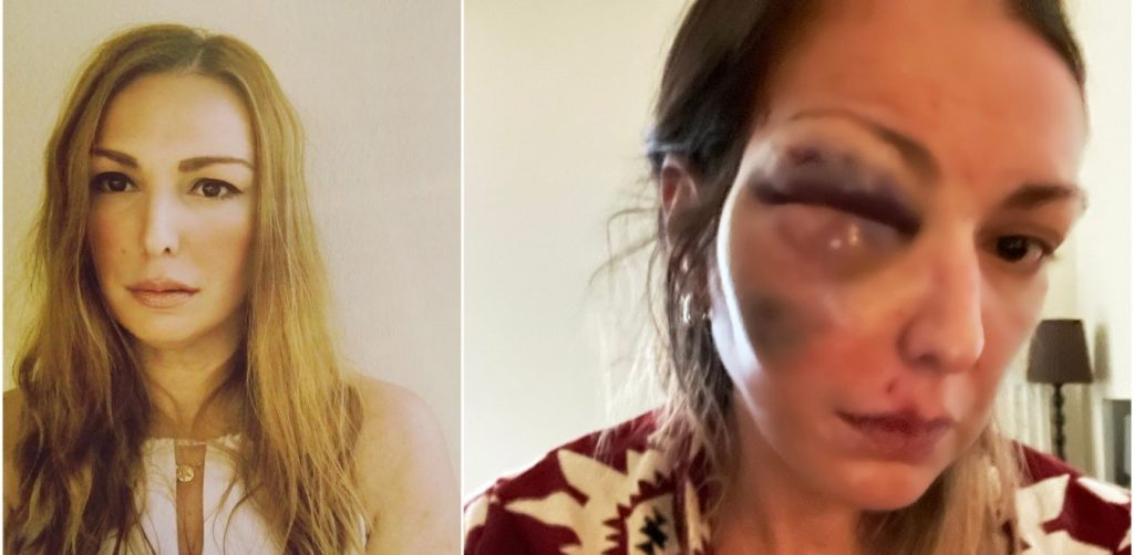 Συγκλονίζει η food blogger Στεφανία Τζαφέρη για τον ξυλοδαρμό – «Με απειλούσαν ότι θα μου κλείσουν και το άλλο μάτι»