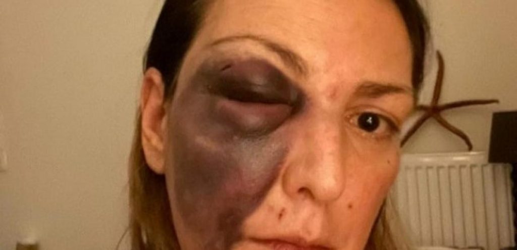 Food blogger που ξυλοκοπήθηκε: «Δέχτηκα απειλές ότι θα μου κλείσουν και το άλλο μάτι»