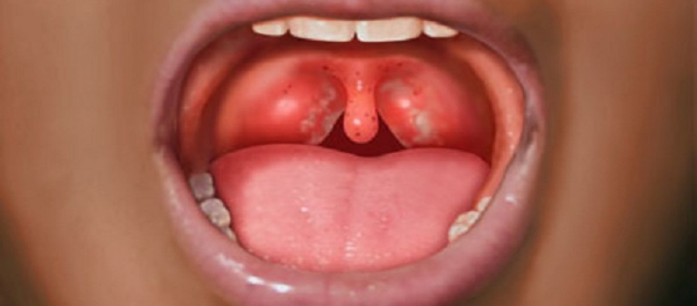 Αυτό είναι το πρόβλημα στο στόμα που αυξάνει τον κίνδυνο για καρκίνο