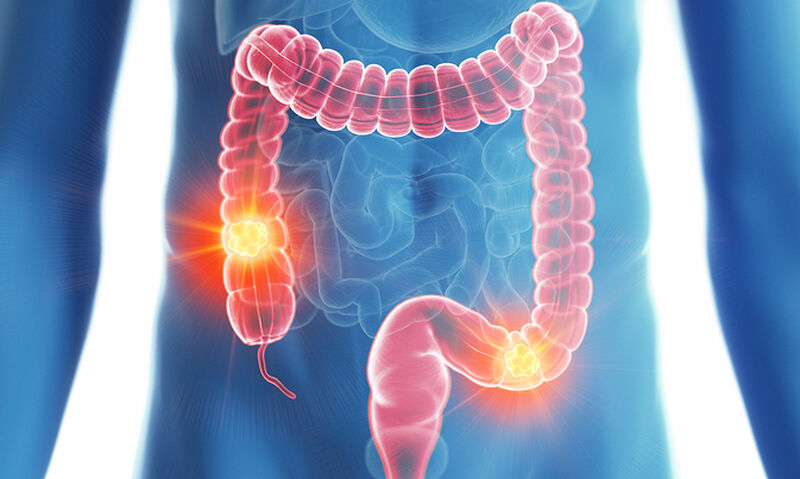 Καρκίνος παχέος εντέρου: Το νου σας σε αυτόν τον μεγάλο ένοχο για την πρόκλησή του