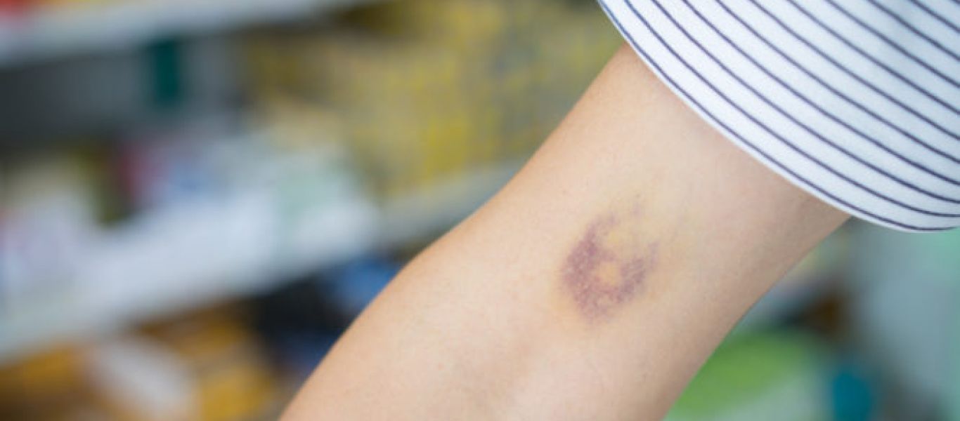 Ανεξήγητες μελανιές: Τι μπορεί να σημαίνουν;