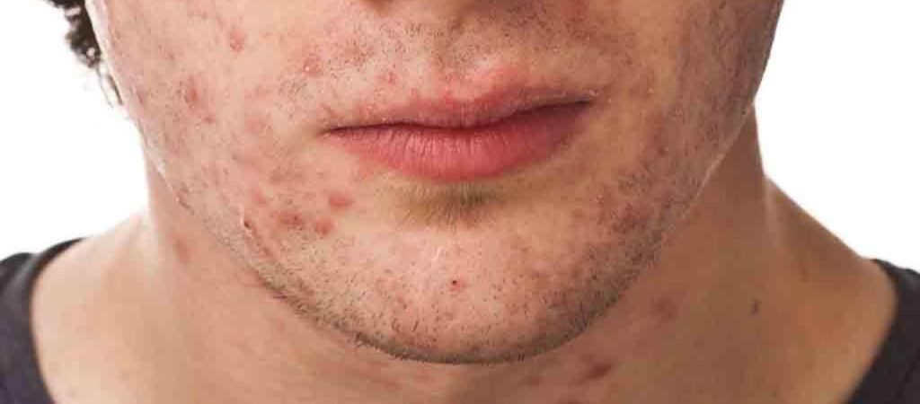 Η ακμή μπορεί να επηρεάσει και την ψυχική υγεία των ανδρών – Συχνό φαινόμενο