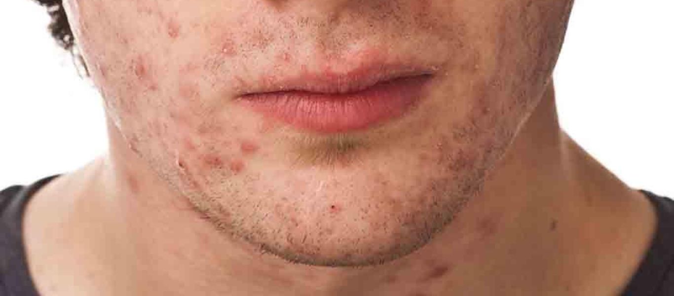 Η ακμή μπορεί να επηρεάσει και την ψυχική υγεία των ανδρών – Συχνό φαινόμενο