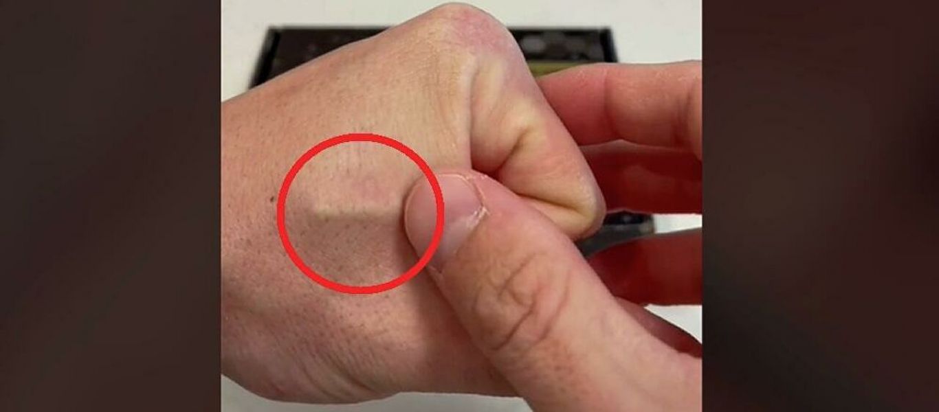 Βίντεο: Άντρας έβαλε τσιπάκι κάτω από το δέρμα – Πώς προωθείται «αθώα» το «σφράγισμα»