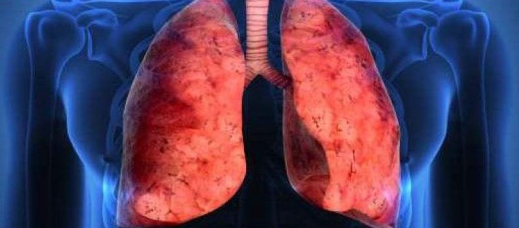 Πνευμονία: Αίτια, συμπτώματα και όλα όσα πρέπει να γνωρίζετε