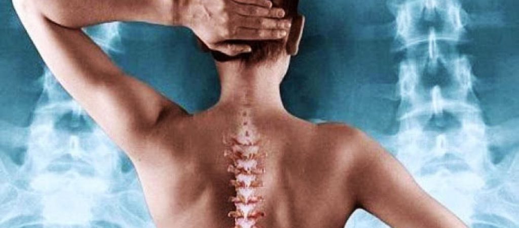 Οστεοπόρωση: Ποιοι είναι οι παράγοντες που αυξάνουν τον κίνδυνο; – Να γιατί δεν απειλεί όλες τις γυναίκες