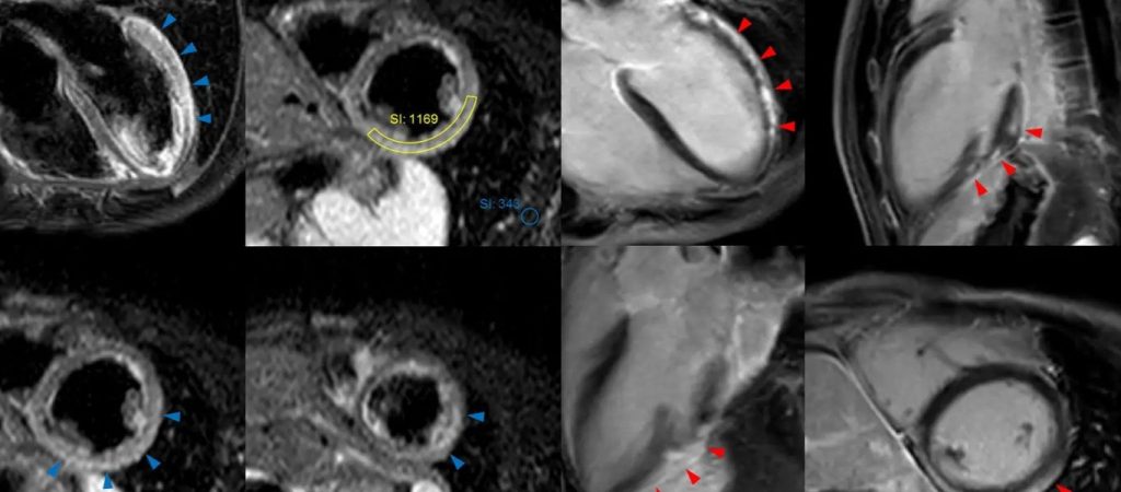 Εμβόλιο Pfizer: Κινεζική μελέτη δίνει τετραπλάσιες πιθανότητες για μυοκαρδίτιδα σε σχέση με τα στοιχεία του ΕΜΑ