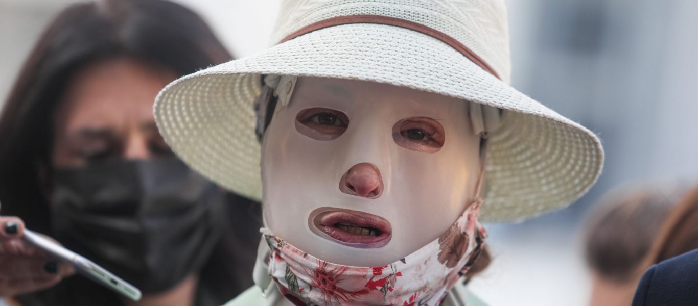 Επίθεση με βιτριόλι: Η Ιωάννα Παλιοσπύρου επέστρεψε στο Παρίσι για νέο κύκλο θεραπειών