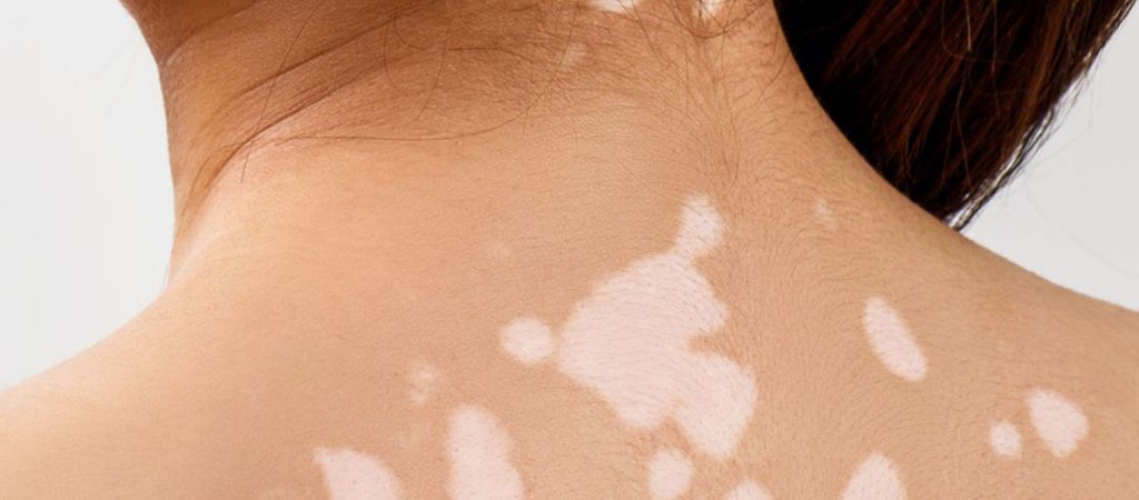 Λεύκη: Τύποι και συμπτώματα – Με ποιες ασθένειες συνδέεται;