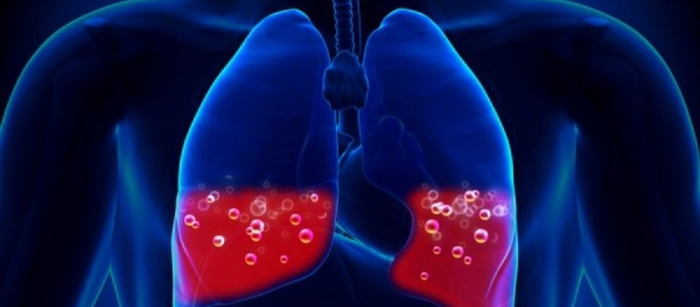 Πνευμονική εμβολή: Προσοχή αν νιώσετε αυτά τα σημάδια – Όλα όσα πρέπει να γνωρίζετε