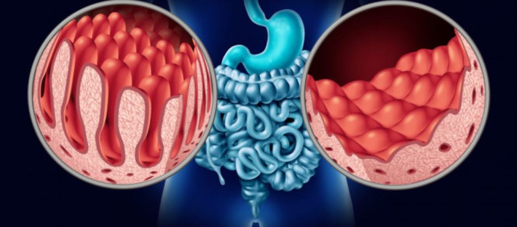 Κοιλιοκάκη: Μετά από ποια συμπτώματα πρέπει να κόψετε την γλουτένη;