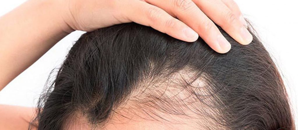 Τριχόπτωση τέλος: Aυτά είναι τα φρούτα που την καταπολεμούν