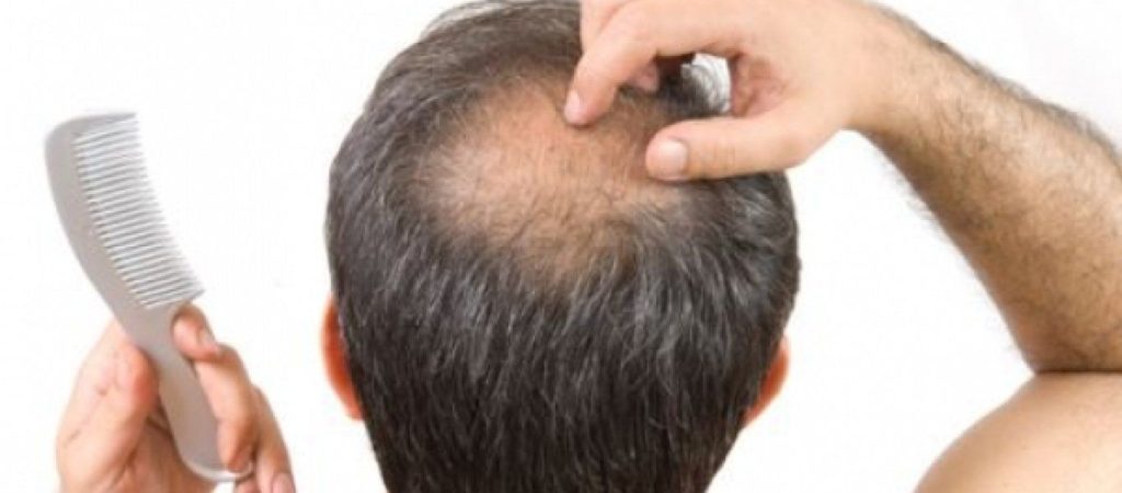 Όσα πρέπει να ξέρετε για τη γυροειδή αλωπεκία – Έτσι θα την περιορίσετε για να μην εξαπλωθεί