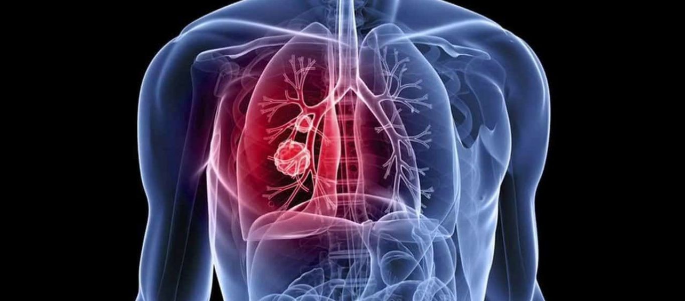 Η «μαγική» τροφή που μπορεί να βοηθήσει στον καρκίνο του πνεύμονα