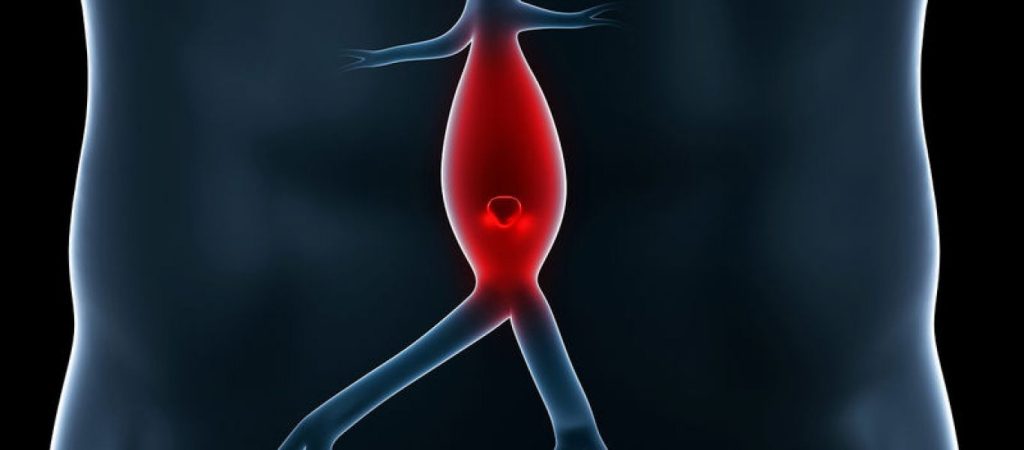 Αυτοί είναι οι τέσσερις παράγοντες που προβλέπουν αν ένα ανεύρυσμα θα σπάσει