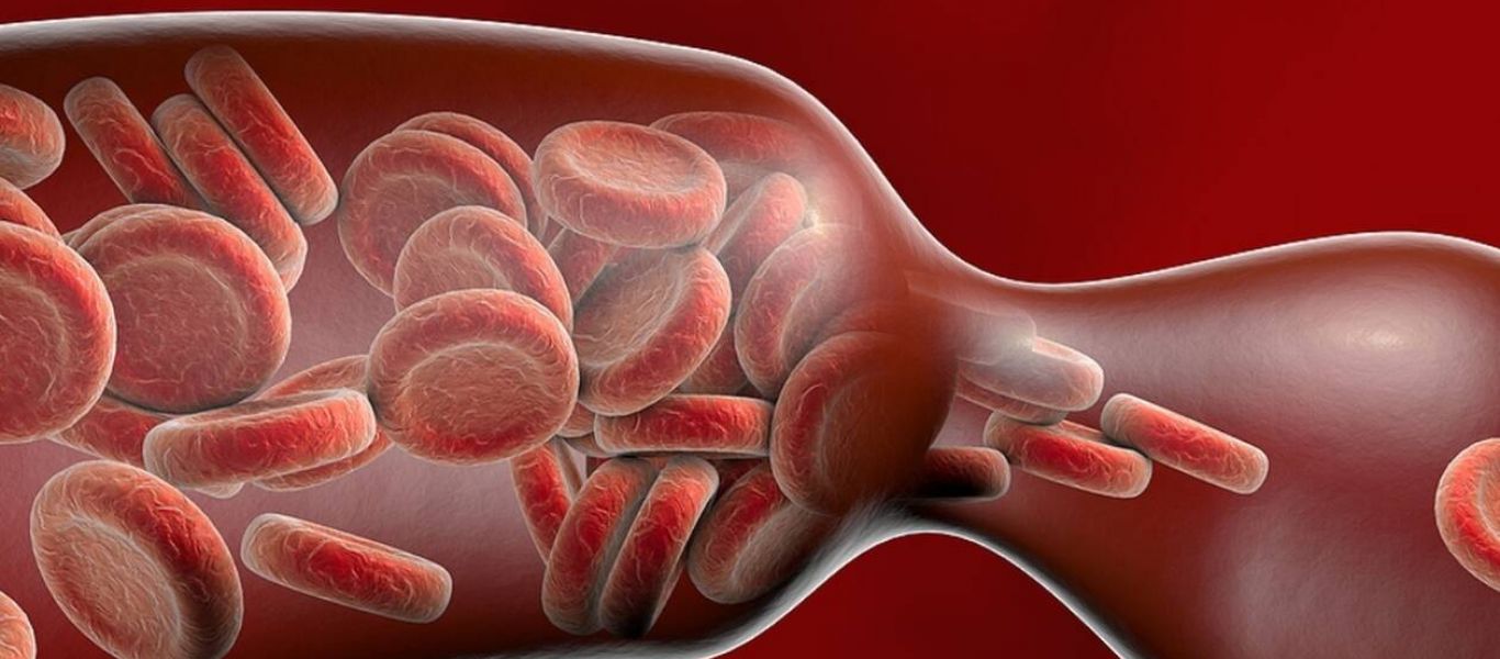 Θρόμβος αίματος σε αρτηρία ή σε φλέβα: Τι θα νιώσετε στην κάθε περίπτωση – Όλα τα συμπτώματα