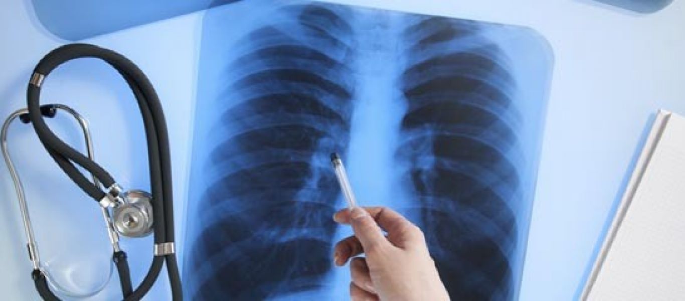Δεν χρειάζεται να καπνίζετε για να πάθετε καρκίνο του πνεύμονα – Τα συμπτώματα που πρέπει να γνωρίζετε