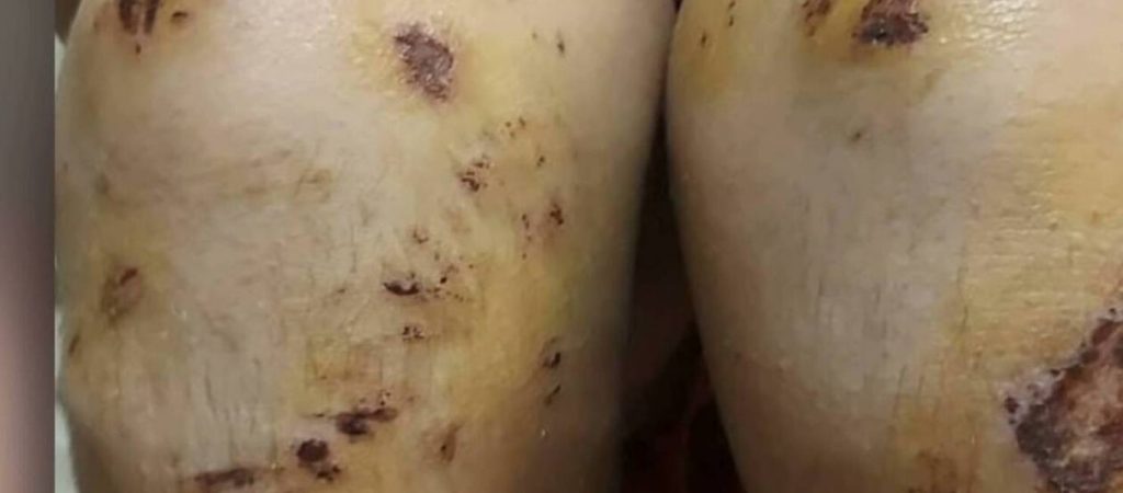 Εικόνα-σοκ από τον 14χρονο που ξυλοκοπήθηκε στη Θεσσαλονίκη: Δείτε τα τραύματά του