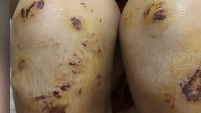 Εικόνα-σοκ από τον 14χρονο που ξυλοκοπήθηκε στη Θεσσαλονίκη: Δείτε τα τραύματά του