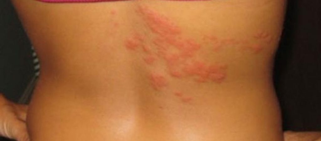 Έρπης ζωστήρας: Τι προκαλεί στο δέρμα και τι άλλα συμπτώματα θα νιώσετε