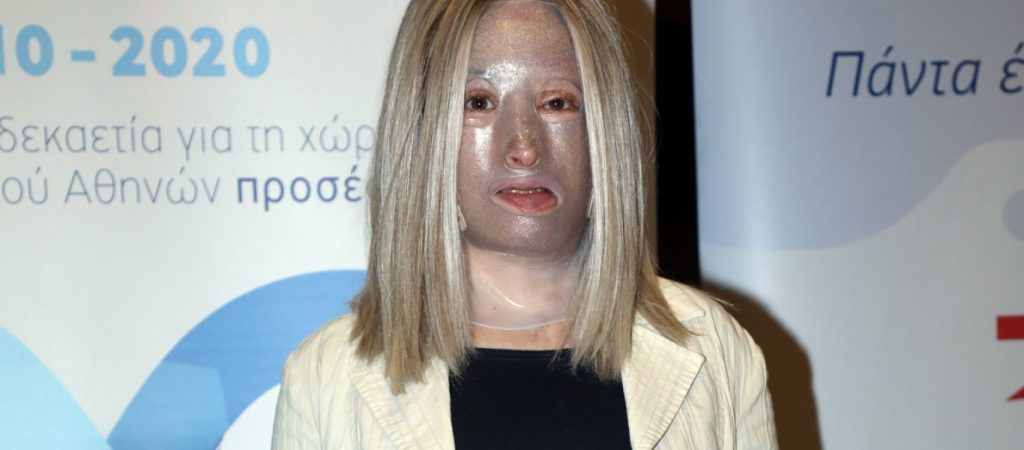 Επίθεση με βιτριόλι: Η Ιωάννα Παλιοσπύρου αποκαλύπτει πότε θα βγάλει τη μάσκα