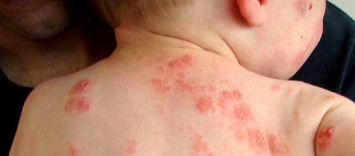 Σταφυλόκοκκος στο παιδί: Όλα όσα πρέπει να γνωρίζουν οι γονείς